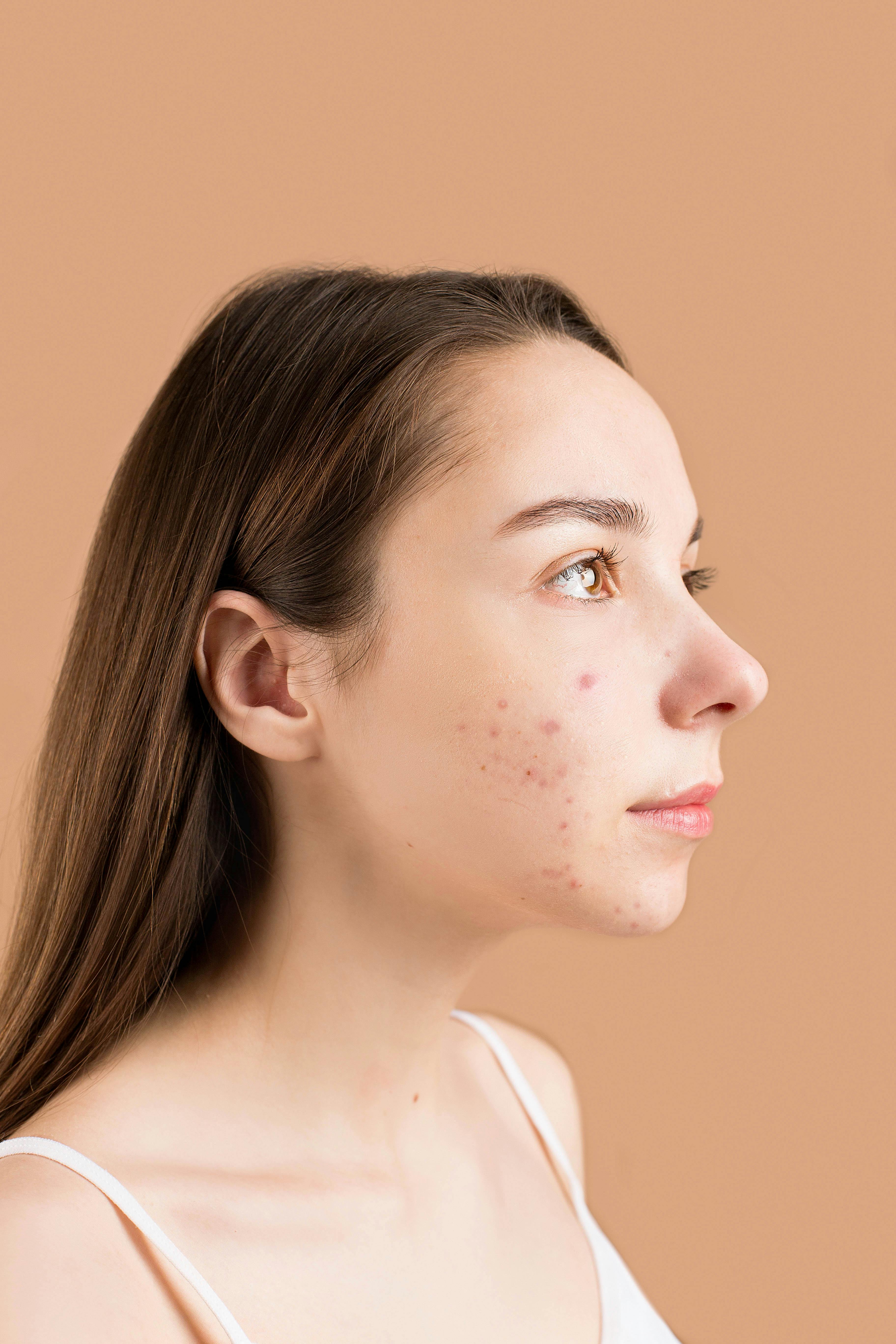 Acne pre-ciclo: cause ormonali spiegate semplicemente